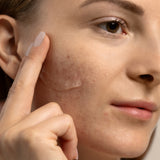 Acne Care Phage Gel