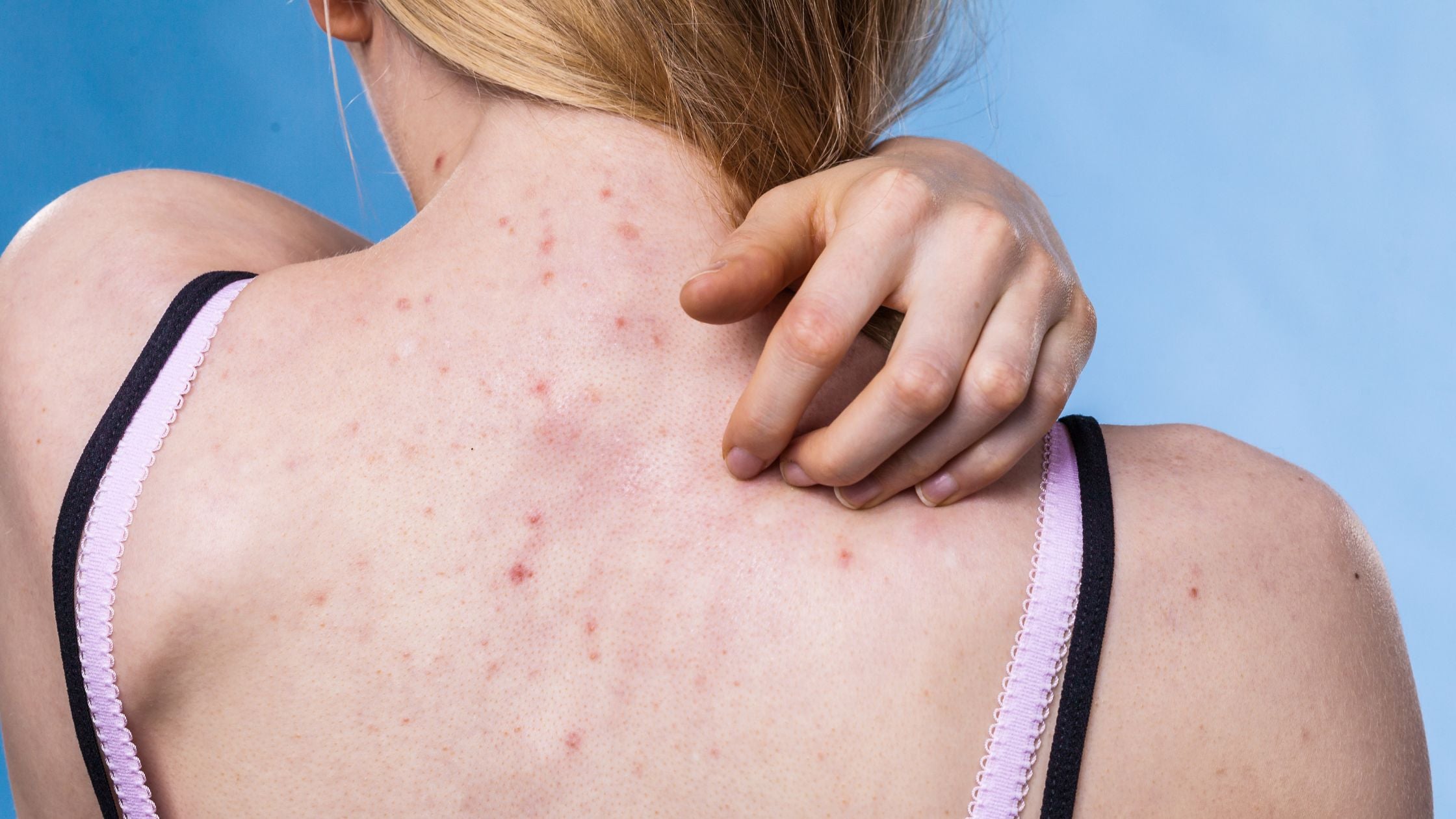 Acneea pe spate și piept: cauze, îngrijire după sală și când să mergi la dermatolog